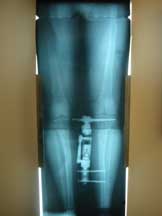 X-ray of leg with fixator in place
