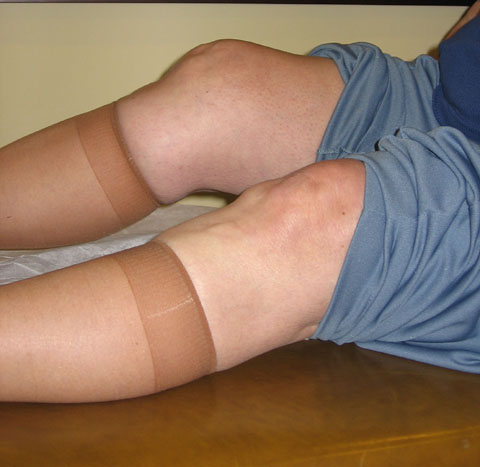 Image of a person with a large flexion contracture
