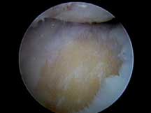 Microfracture Image 1