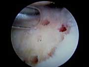 Microfractur